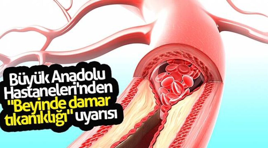 Büyük Anadolu Hastaneleri'nden "Beyinde damar tıkanıklığı" uyarısı