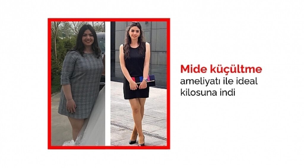 Mide küçültme ameliyatı ile ideal kilosuna indi