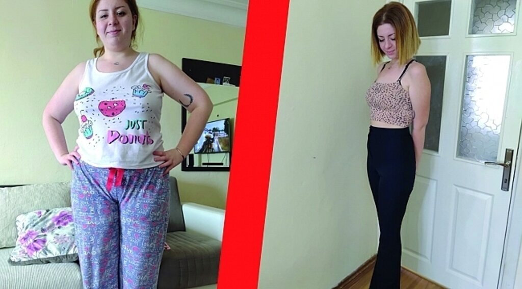 Tüp mide ameliyatı oldu görenleri şaşkına uğrattı