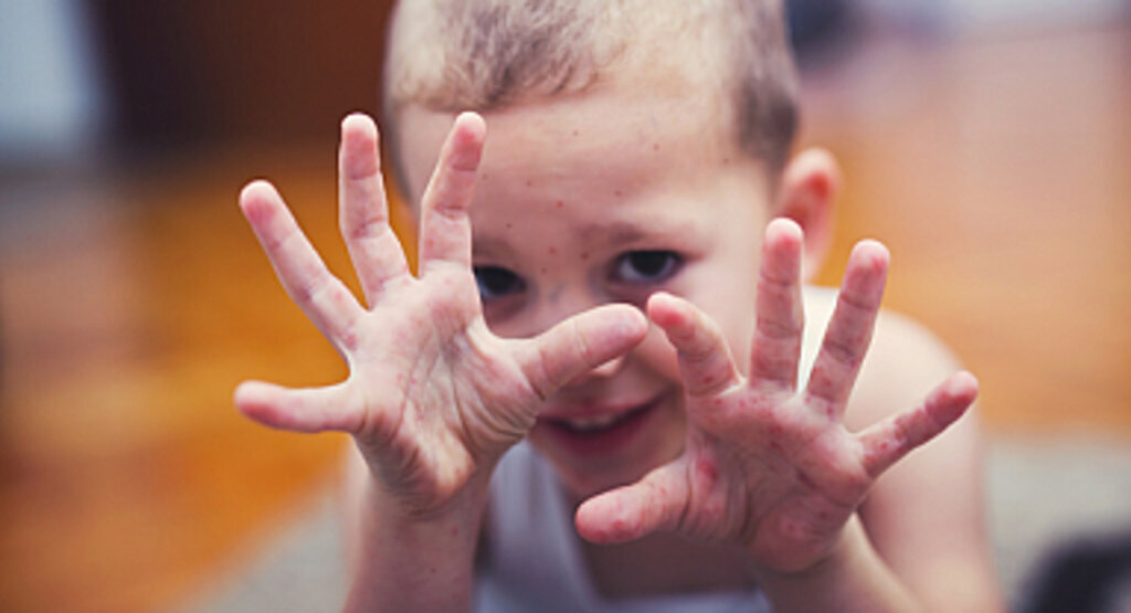 El Ayak Ağız Hastalığı Nedir? Belirtileri ve Tedavisi